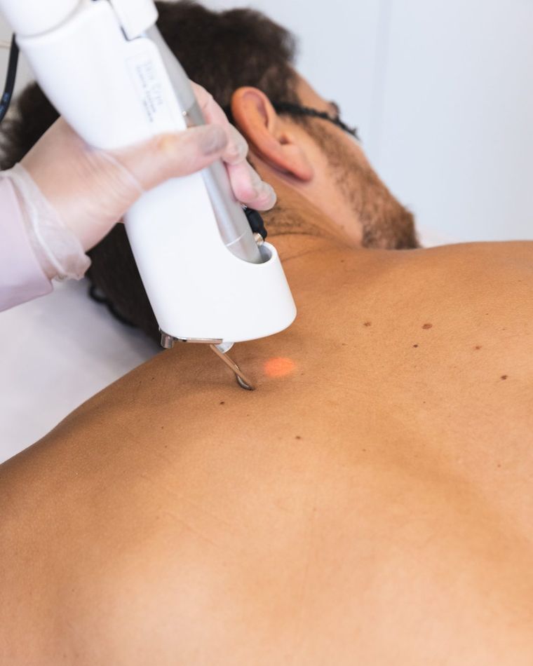 Depilação a laser de costas