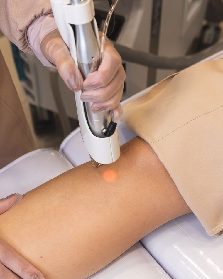 Depilação a laser de pernas